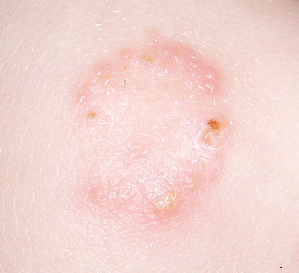Ringworm